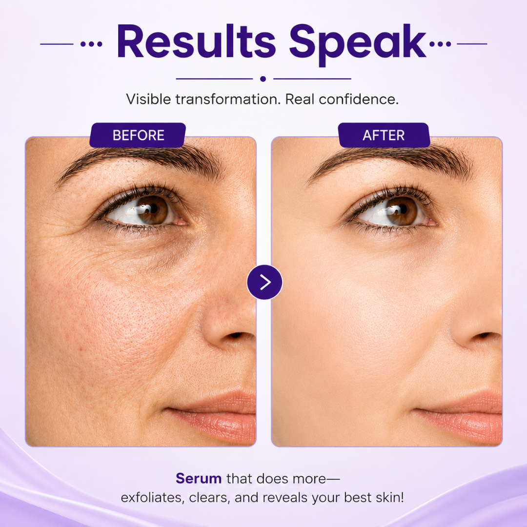 Before and after skin transformation showing reduced pores, smoother skin texture, and clear complexion with Salicylic Acid Serum.