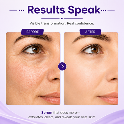 Before and after skin transformation showing reduced pores, smoother skin texture, and clear complexion with Salicylic Acid Serum.